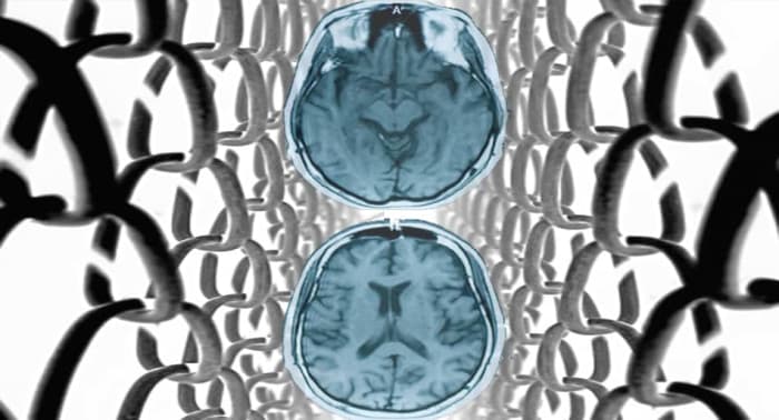 study-41-percent-of-retired-fighters-likely-have-cte-mma-underground