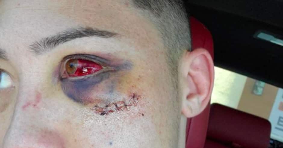 Boston Salmon suffers broken orbital from illegal knee