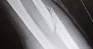 Brett Rogers fought Alexander Volkov with one very broken arm