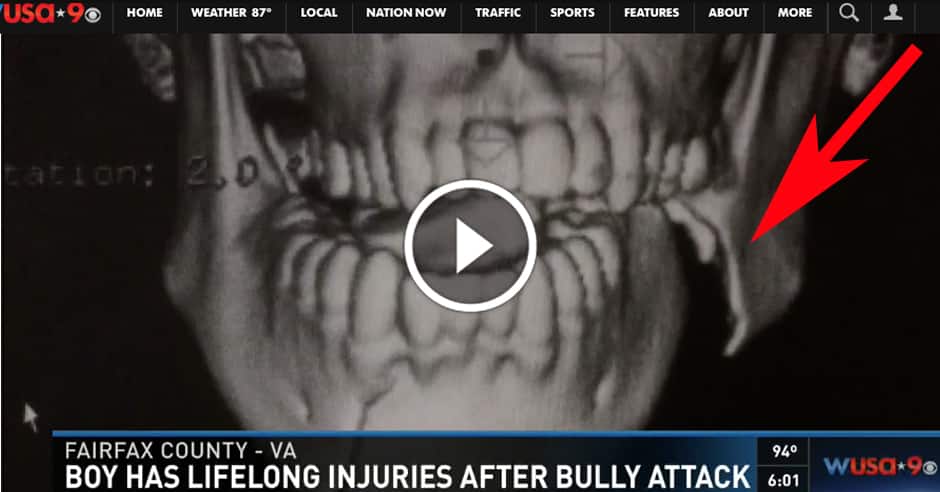 Bullying incident leaves Virginia boy with lifelong injury