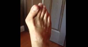 Cung Le bleeds his broken foot
