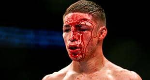 UFC legend Diego Sanchez hospitalized with COVID-related pneumonia and blood clots