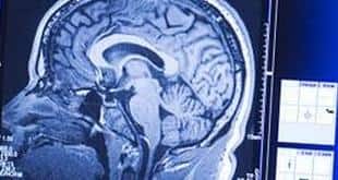 Study: One in 5,000 pro boxing bouts ends in death by brain injury