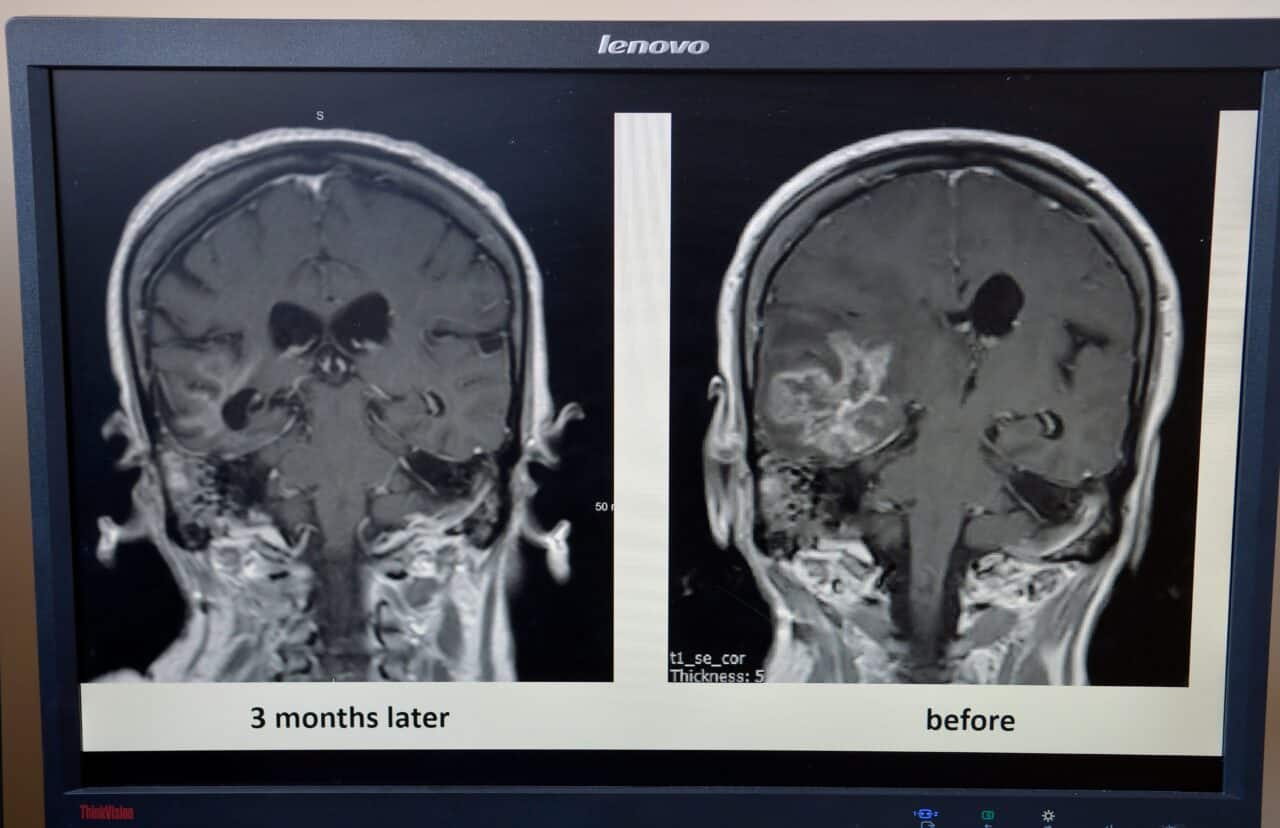 Are radiologists ignoring possible brain injuries in MMA fighters?