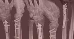 UFC 98 Medical Suspensions