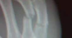 X-Ray images of Faber’s broken hand